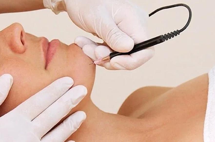Professional laser hair removal machine used in UK clinic