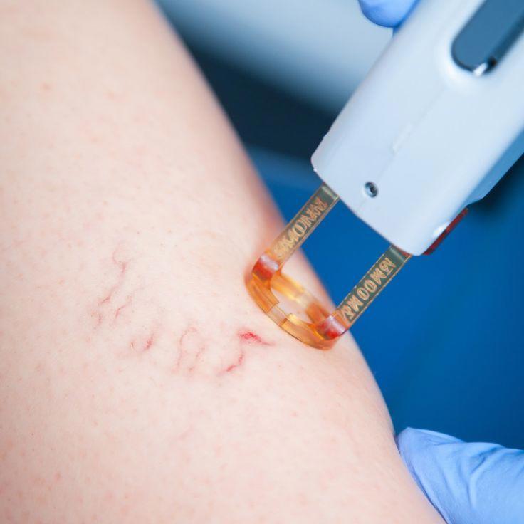 Close-up of facial thread veins before treatment