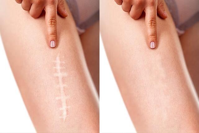 Scar reduction treatment in Scotter DN21 clinic.