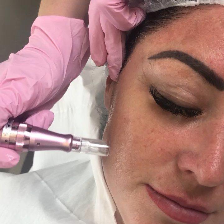 Close-up of Derma Pen microneedling device in use