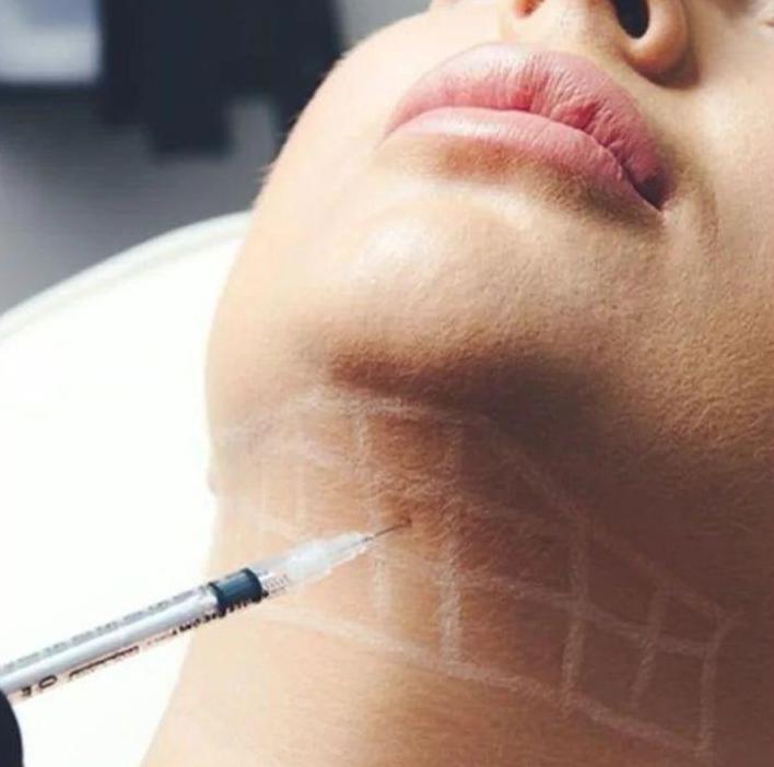 Aqualyx fat dissolving injection into double chin area