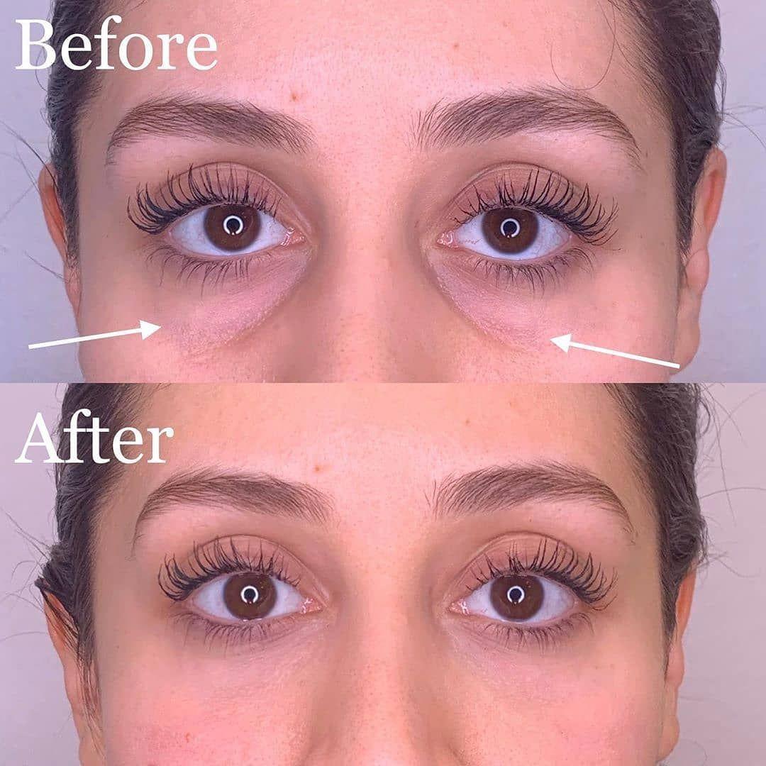 Topilase filler correction treatment on lips