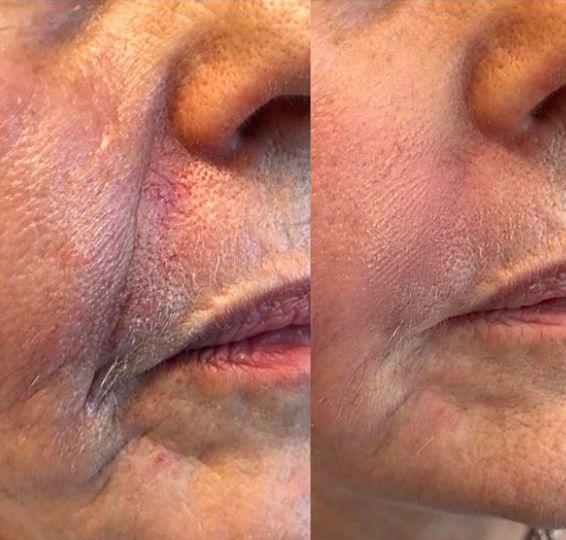 Filler dissolving consultation at aesthetic clinic