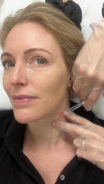 Ejal 40 skin booster treatment on neck area