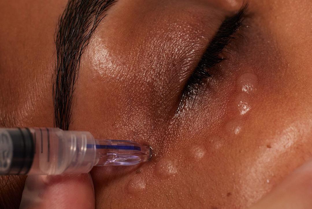 Lumi Eyes treatment for dark circles and tired eyes