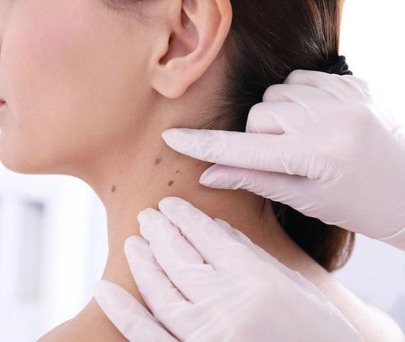 Before and after mole removal using mycrolysis