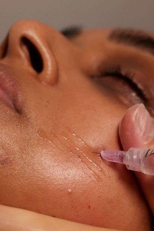 Mesotherapy injection into facial skin for rejuvenation