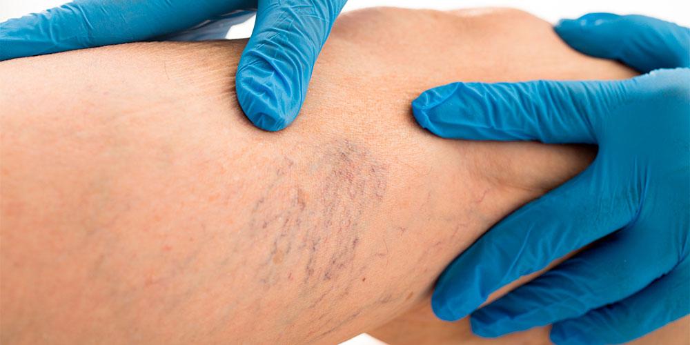 Laser hair removal treatment in progress